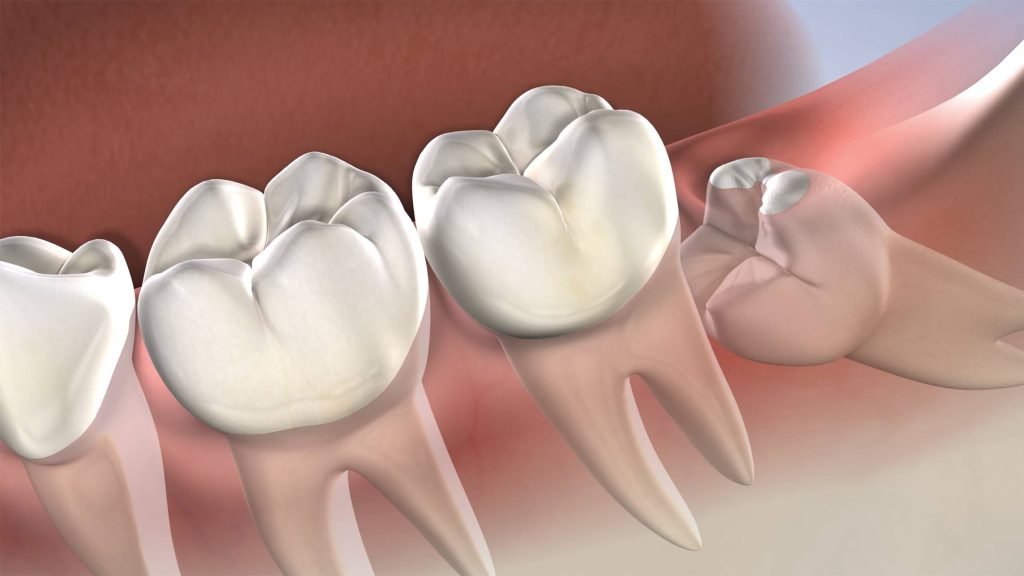 Surgical Extraction of Withdom tooth